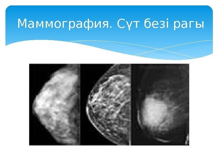 Маммография. Сүт безі рагы  