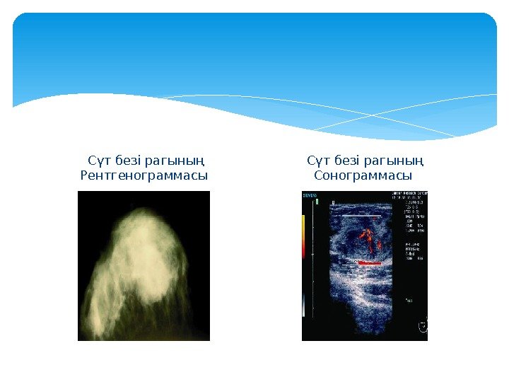  Сүт безі рагының Рентгенограммасы Сүт безі рагының Сонограммасы  