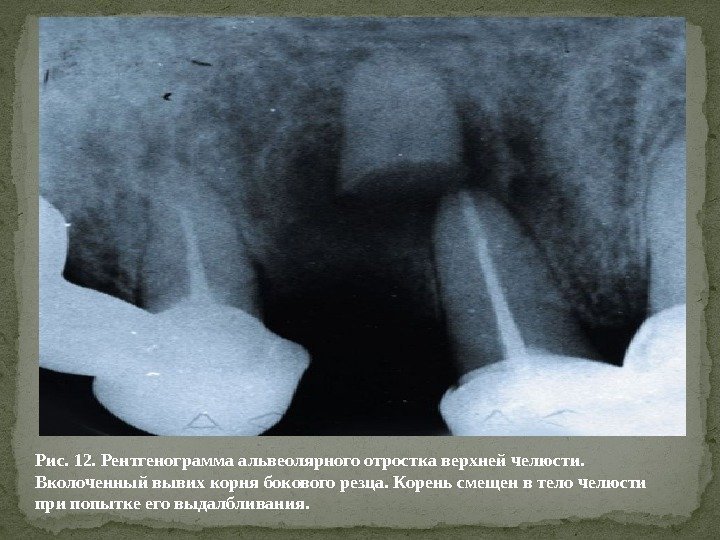 Рис. 12. Рентгенограмма альвеолярного отростка верхней челюсти.  Вколоченный вывих корня бокового резца. Корень