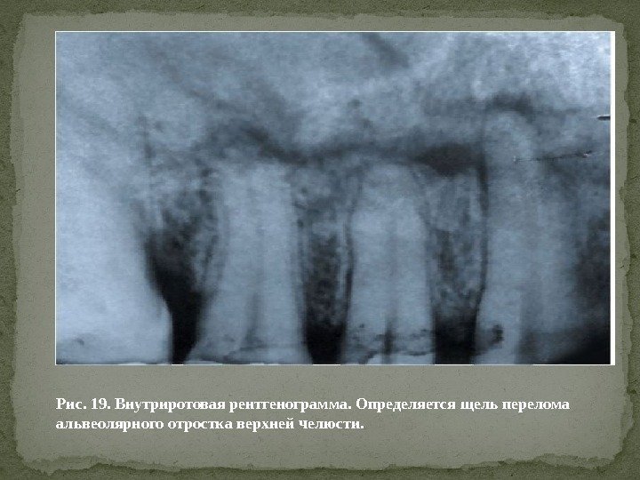 Рис. 19. Внутриротовая рентгенограмма. Определяется щель перелома альвеолярного отростка верхней челюсти. 