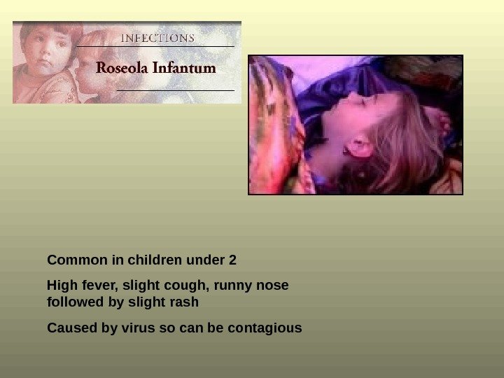Common in children under 2 High fever, slight cough, runny nose followed by slight