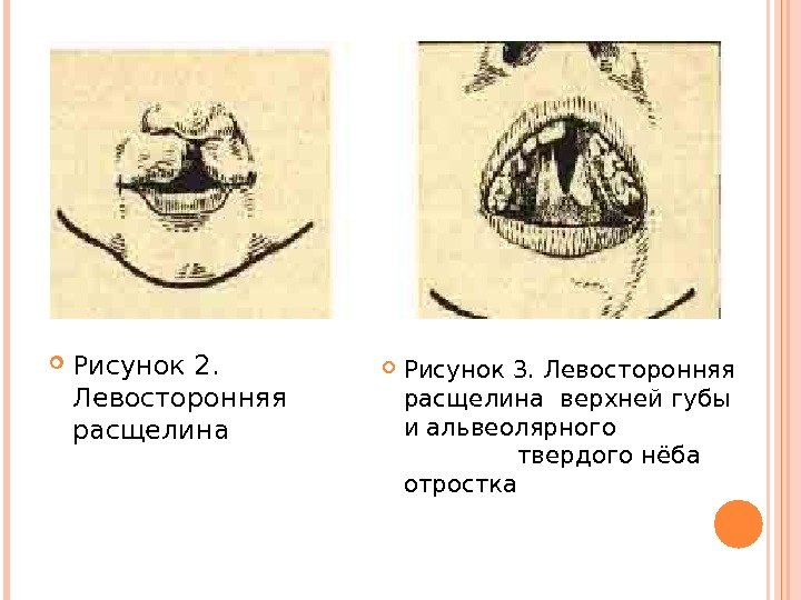  Рисунок 2.  Левосторонняя расщелина Рисунок 3. Левосторонняя расщелина верхней губы и альвеолярного