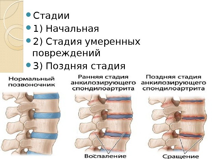  Стадии 1) Начальная 2) Стадия умеренных повреждений 3) Поздняя стадия  