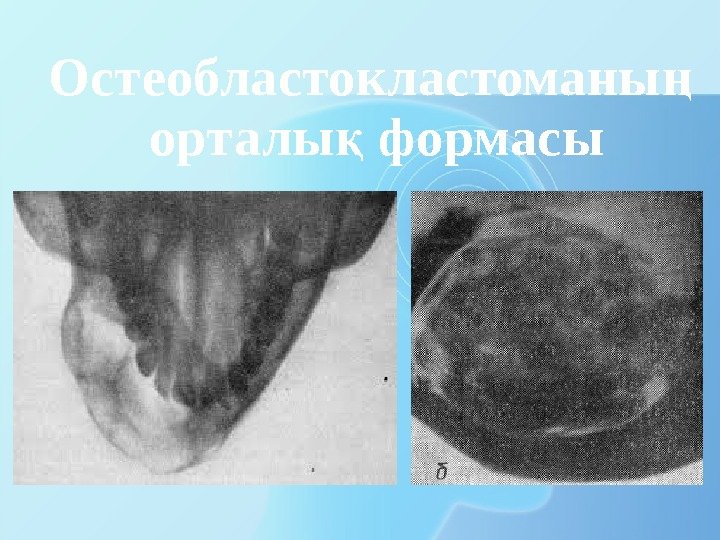 Остеобластокластоманы ң орталы формасы қ 