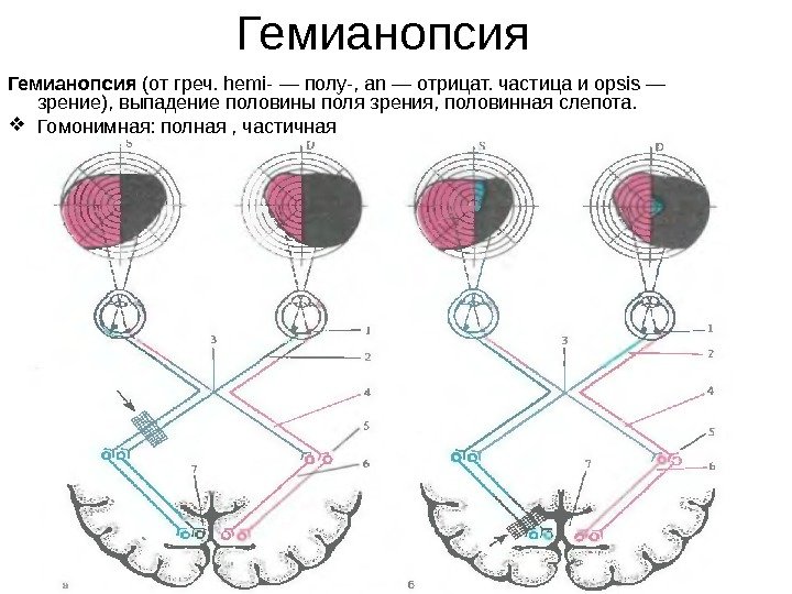 Гемианопсия (от греч. hemi- — полу-, an — отрицат. частица и opsis — зрение),