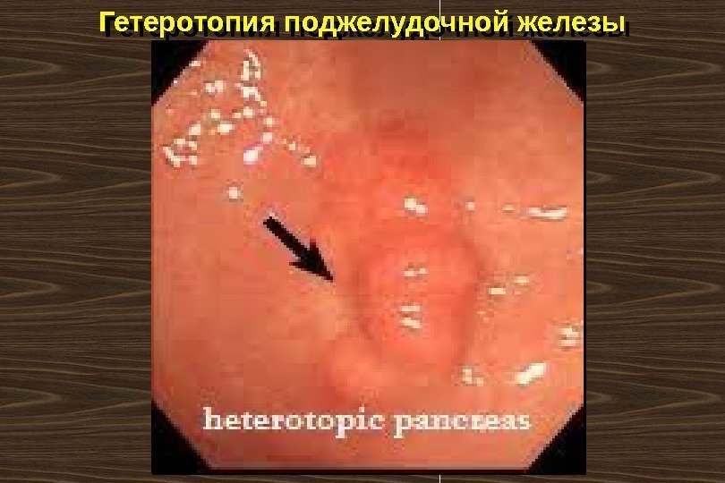 Гетеротопия поджелудочной железы 