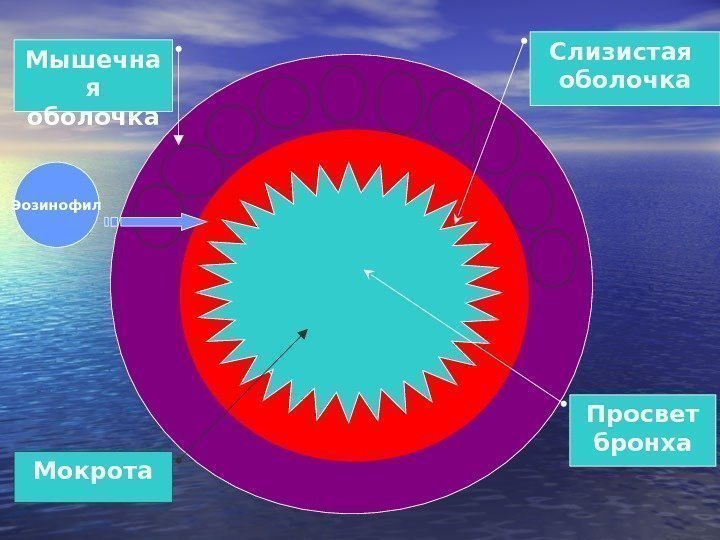   Мышечна я оболочка Эозинофил Просвет бронха Мокрота Слизистая оболочка 