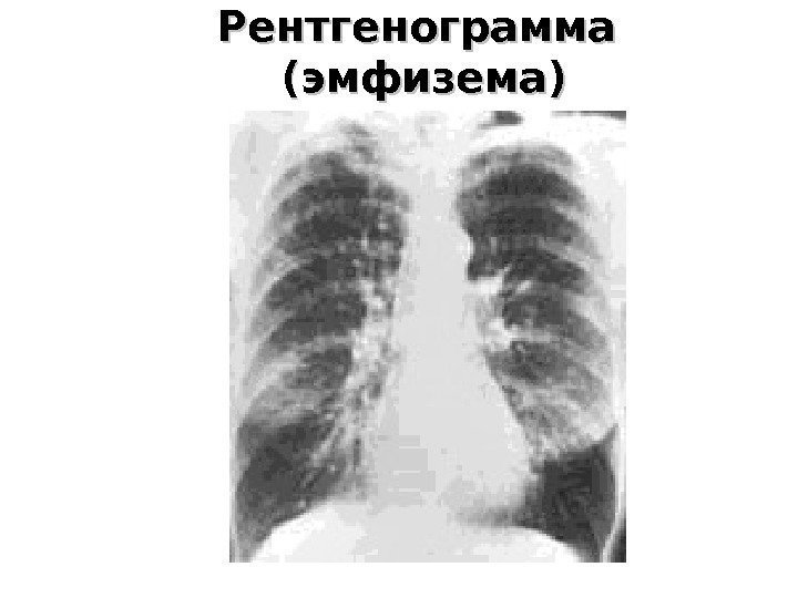 Рентгенограмма  (эмфизема) 