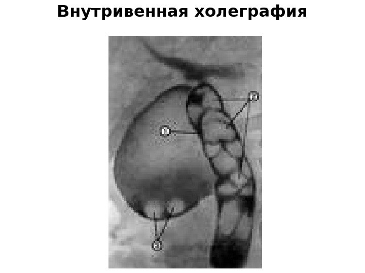 Внутривенная холеграфия 