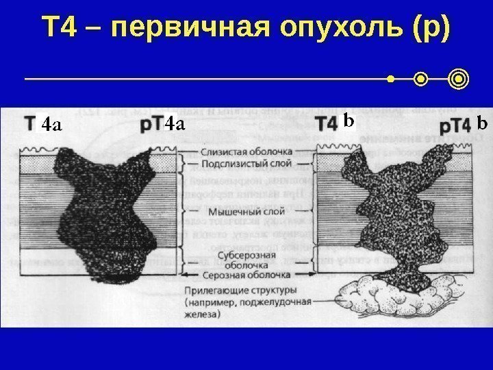 T 4 – первичная опухоль (p) 