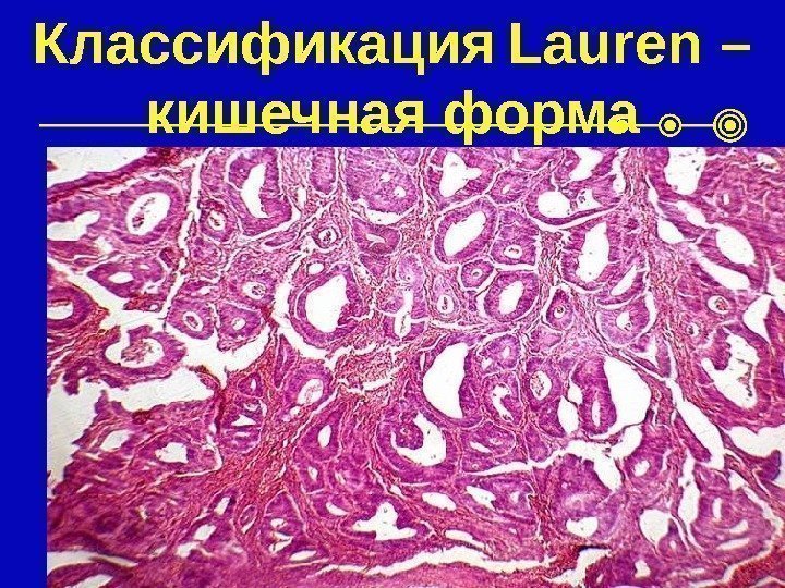 Классификация  Lauren – кишечная форма 