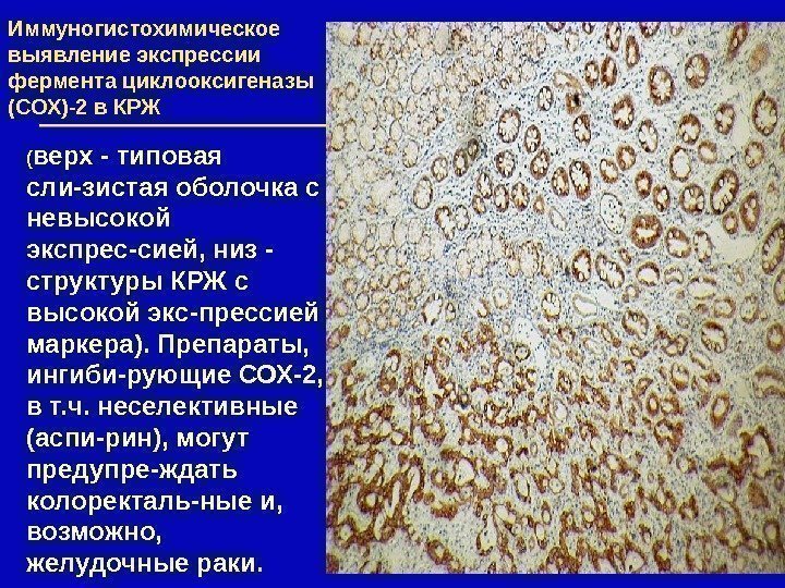 Иммуногистохимическое выявление экспрессии фермента циклооксигеназы (СОХ)-2 в КРЖ ( верх - типовая сли-зистая оболочка