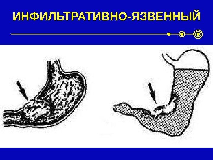 ИНФИЛЬТРАТИВНО-ЯЗВЕННЫЙ 