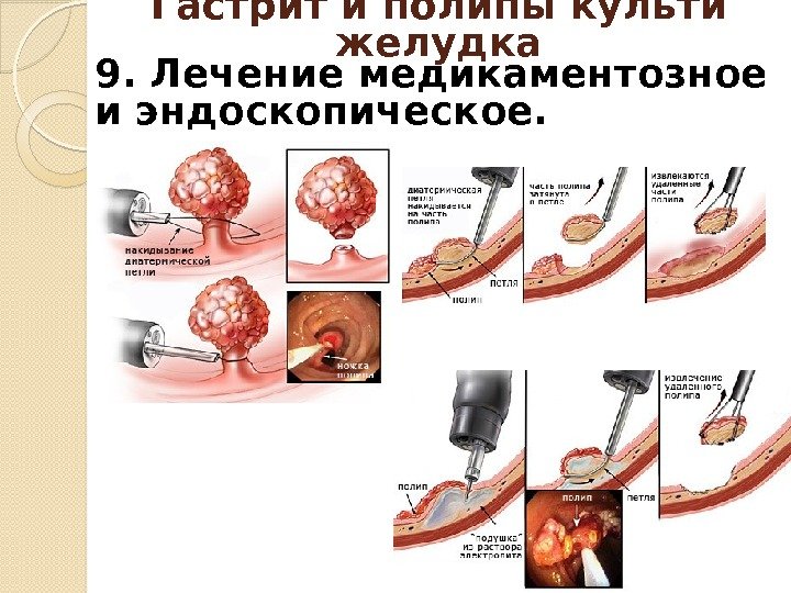 9. Лечение медикаментозное и эндоскопическое. Гастрит и полипы культи желудка  