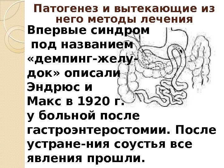 Впервые синдром  под названием  «демпинг-желу- док» описали Эндрюс и Макс в 1920