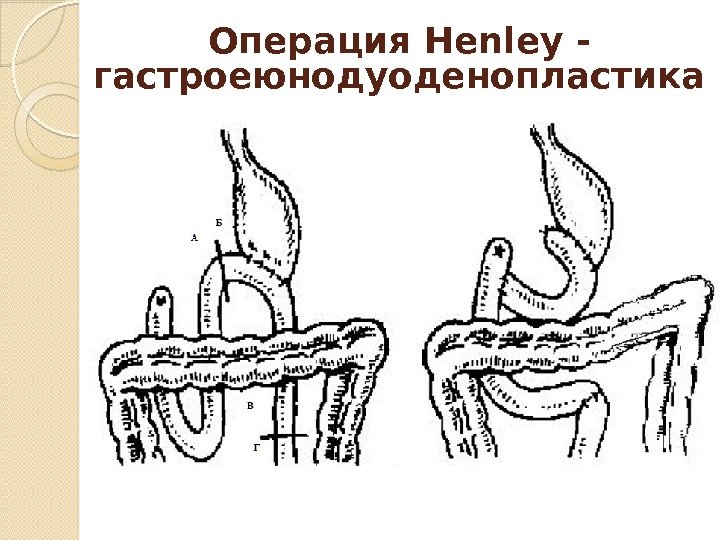 Операция Henley - гастроеюнодуоденопластика  