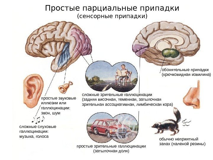 Простые парциальные припадки (сенсорные припадки) простые звуковые иллюзии или галлюцинации: звон, шум сложные слуховые