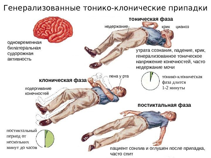 Генерализованные тонико-клонические припадки одновременная билатеральная судорожная активность крик цианоз утрата сознания, падение, крик, генерализованное