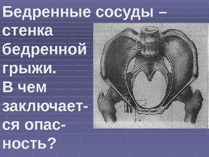 Бедренные сосуды – стенка бедренной грыжи.  В чем заключает- ся опас- ность? 