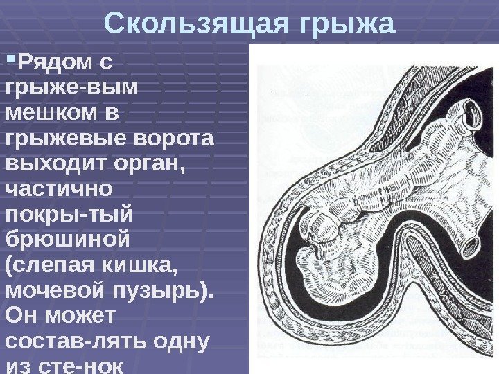 Скользящая грыжа Рядом с грыже-вым мешком в грыжевые ворота выходит орган,  частично покры-тый