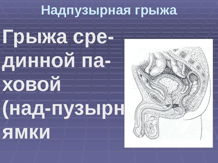 Надпузырная грыжа Грыжа сре- динной па- ховой (над-пузырной) ямки 