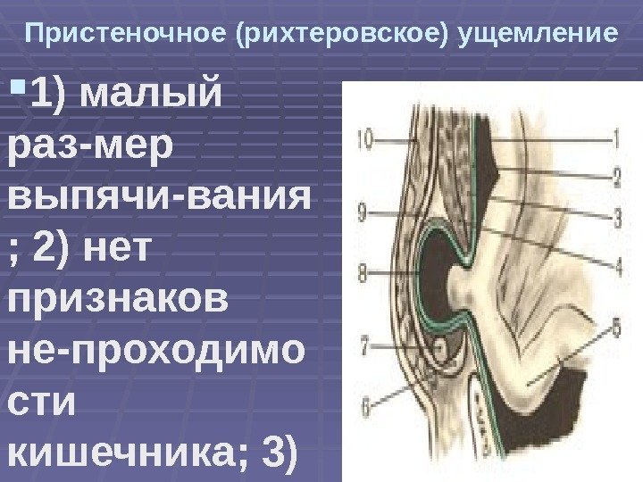 Пристеночное (рихтеровское) ущемление 1) малый раз-мер выпячи-вания ; 2) нет признаков не-проходимо сти кишечника;