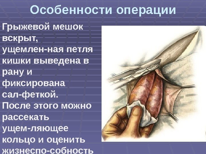 Особенности операции Грыжевой мешок вскрыт,  ущемлен-ная петля кишки выведена в рану и фиксирована