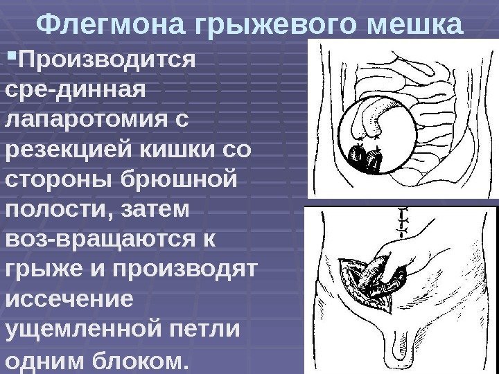 Флегмона грыжевого мешка Производится сре-динная лапаротомия с резекцией кишки со стороны брюшной полости, затем