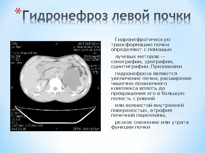  Гидронефротическую трансформацию почки определяют с помощью  лучевых методов — сонографии, урографии, 