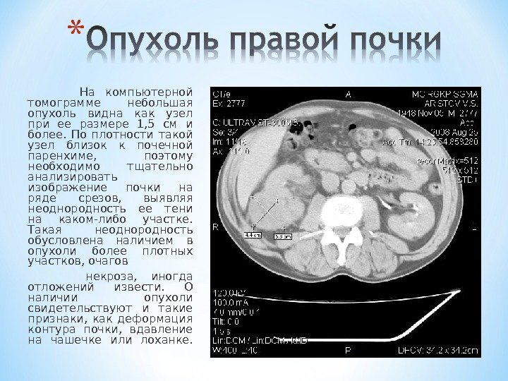   На компьютерной томограмме небольшая опухоль видна как узел при ее размере 1,