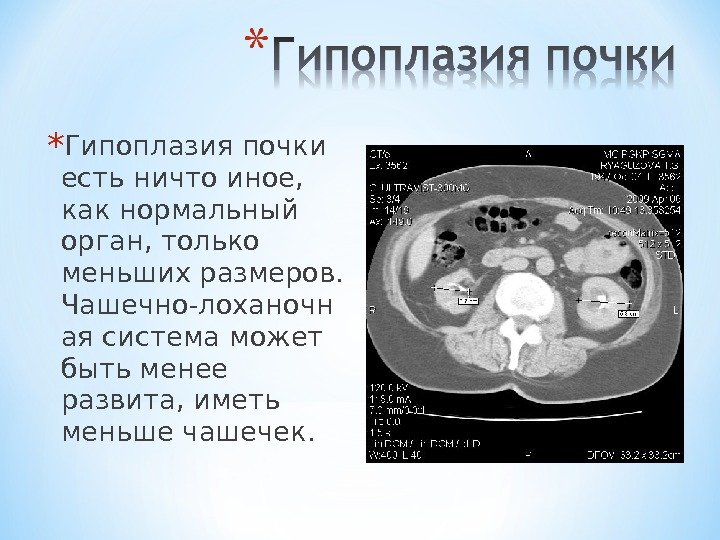 * Гипоплазия почки есть ничто иное,  как нормальный орган, только меньших размеров. 