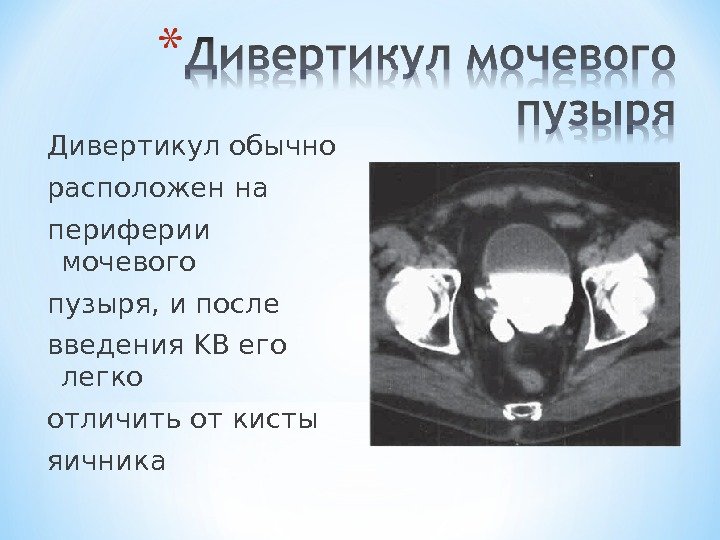 Дивертикул обычно расположен на периферии мочевого пузыря, и после введения KB его легко отличить