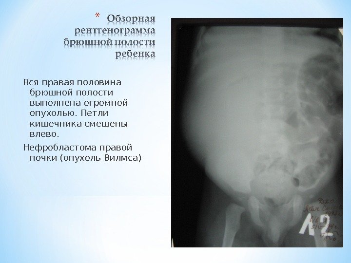 Вся правая половина брюшной полости выполнена огромной опухолью. Петли кишечника смещены влево. Нефробластома правой