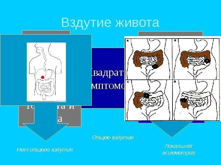 Квадрат симптомов. Боль Задержка стула и газов Тошнота и рвота Вздутие живота  Нет