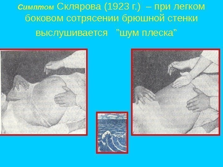 Симптом Склярова (1923 г. ) – при легком боковом сотрясении брюшной стенки выслушивается 