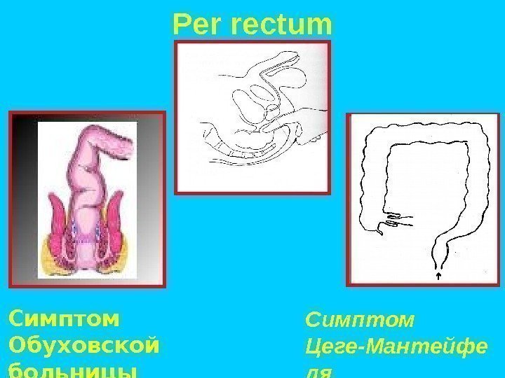 Per rectum  Симптом Цеге-Мантейфе ля. Симптом Обуховской больницы (Грекова) 