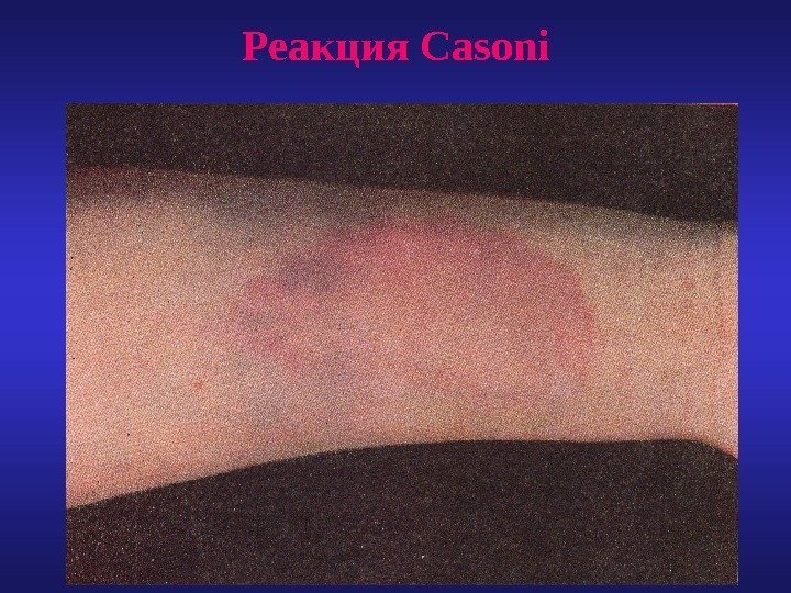 Реакция Casoni 