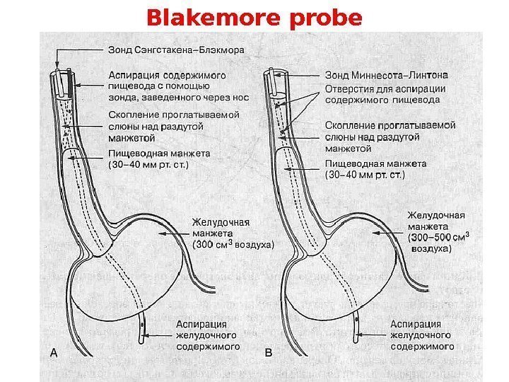 Blakemore probe 