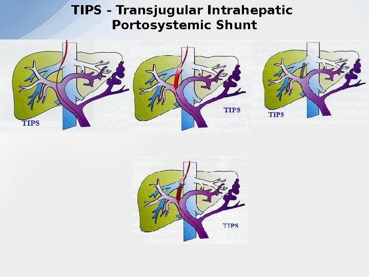 TIPS - Transjugular Intrahepatic Portosystemic Shunt 