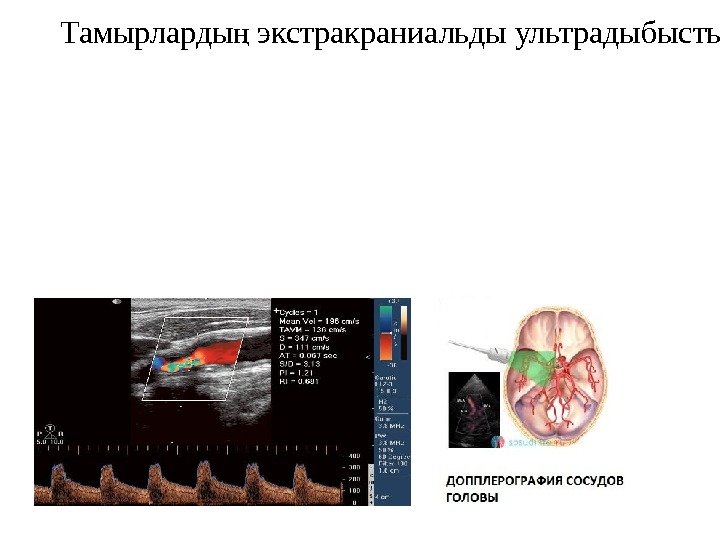 Тамырларды экстракраниальды ультрадыбысты допплерографияң қ 