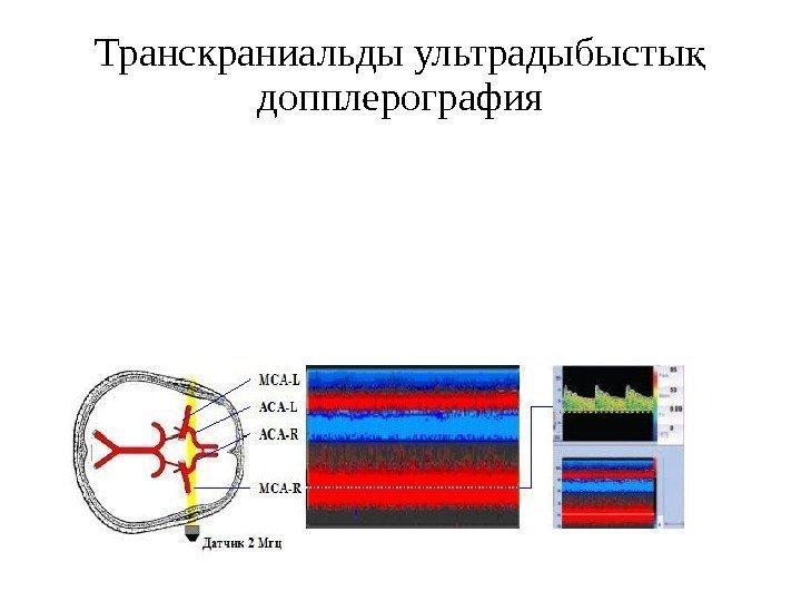 Транскраниальды ультрадыбысты қ допплерография 