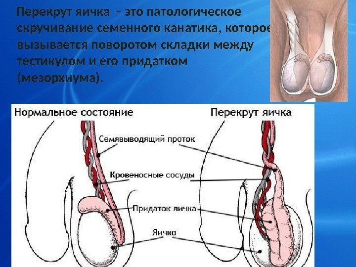 Перекрут яичка – это патологическое скручивание семенного канатика, которое  вызывается поворотом складки