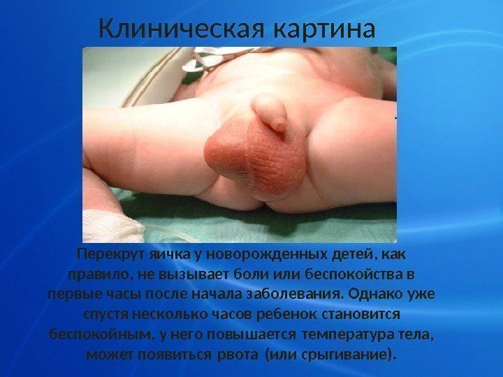 Клиническая картина Перекрут яичка у новорожденных детей, как правило, не вызывает боли или беспокойства