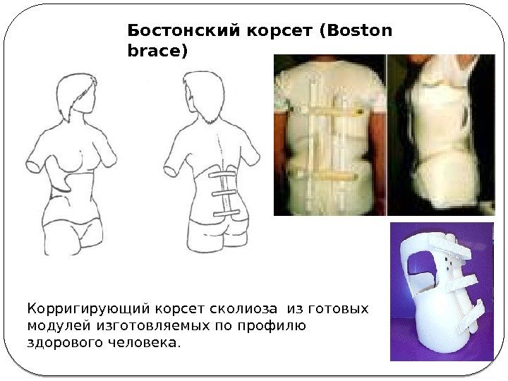 К орригирующий корсет сколиоза изготовых модулей изготовляемых по профилю здорового человека.  Бостонский корсет