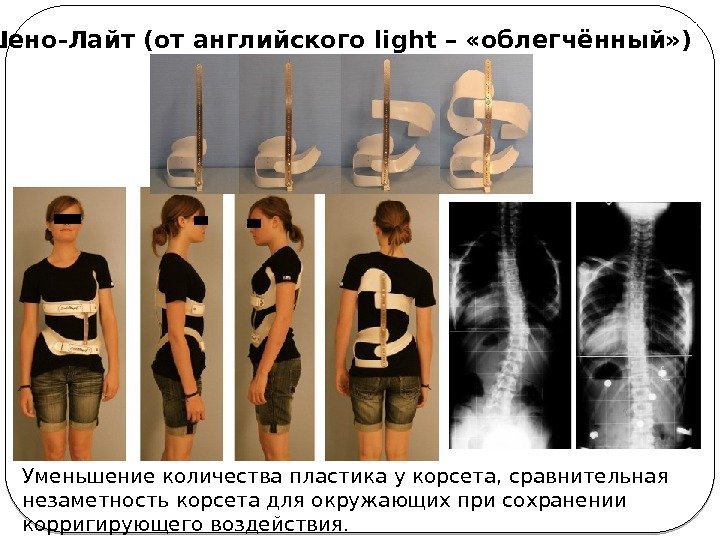 Уменьшение количества пластика у корсета, сравнительная незаметность корсета для окружающих при сохранении корригирующего воздействия.