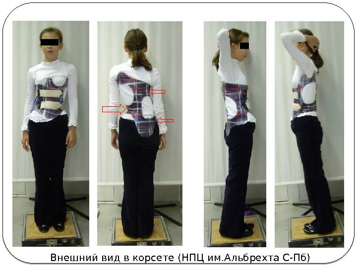 Внешний вид в корсете (НПЦ им. Альбрехта С-Пб) 