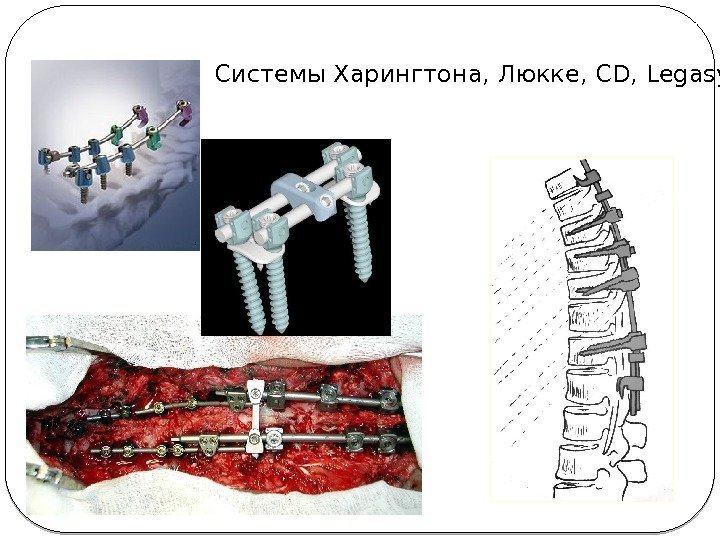 Системы Харингтона, Люкке, CD, Legasy 