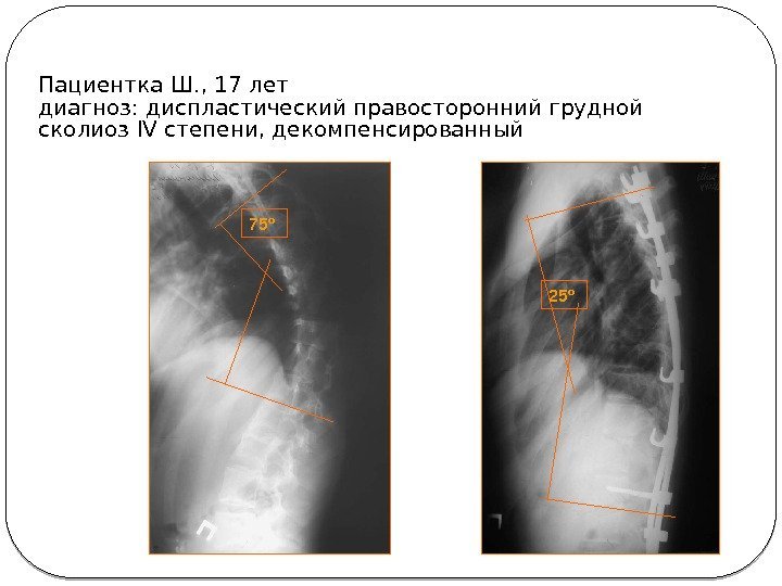 Пациентка Ш. , 17 лет диагноз: диспластический правосторонний грудной сколиоз IV степени, декомпенсированный 75