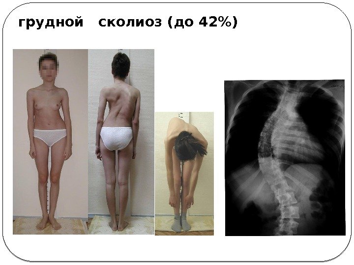 грудной  сколиоз (до 42) 