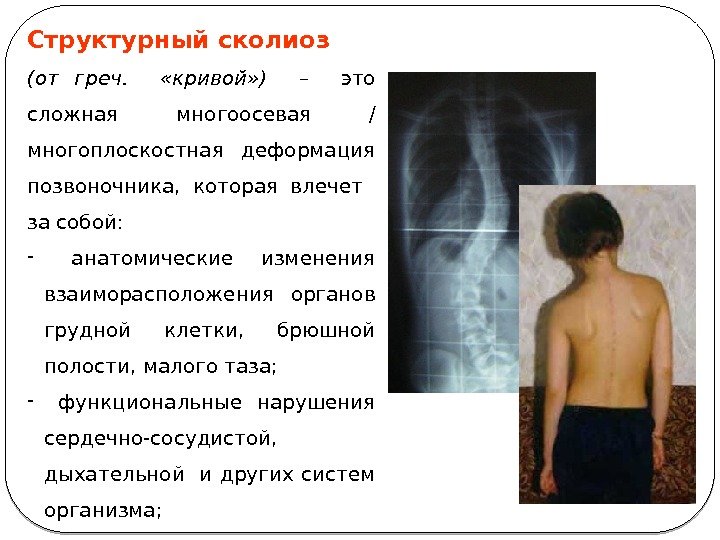 Структурный сколиоз (от греч. «кривой» ) –  это сложная многоосевая / многоплоскостная деформация